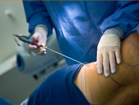 Understanding Liposuction